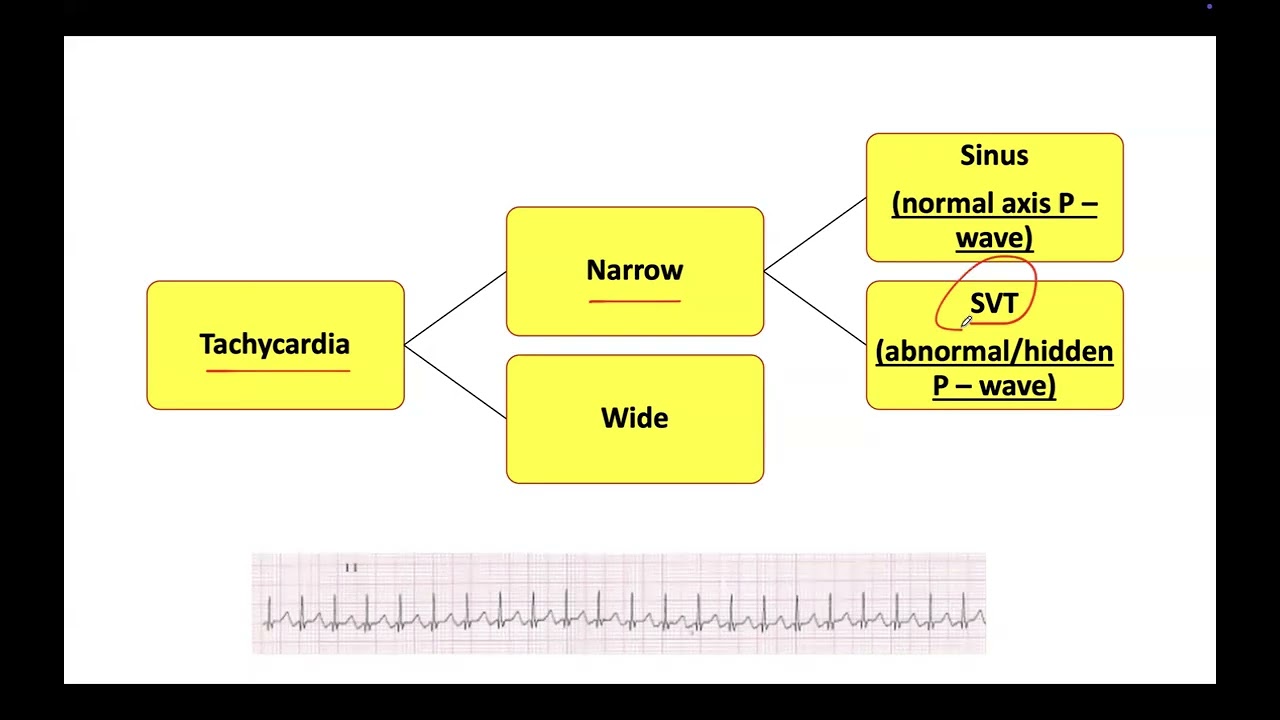 Different SVT types and adenosine/maneuvers to help distinguish between different mechanisms
