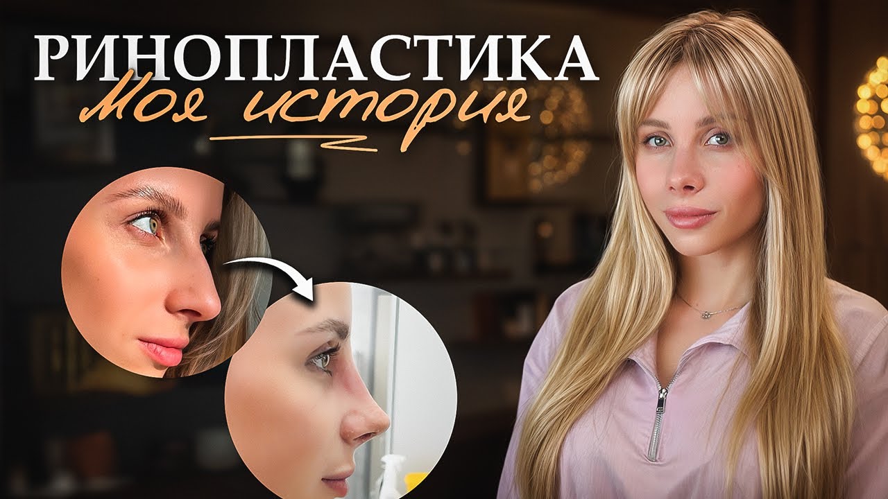 Я мечтала стать красивее, но ринопластика пошла не по плану...