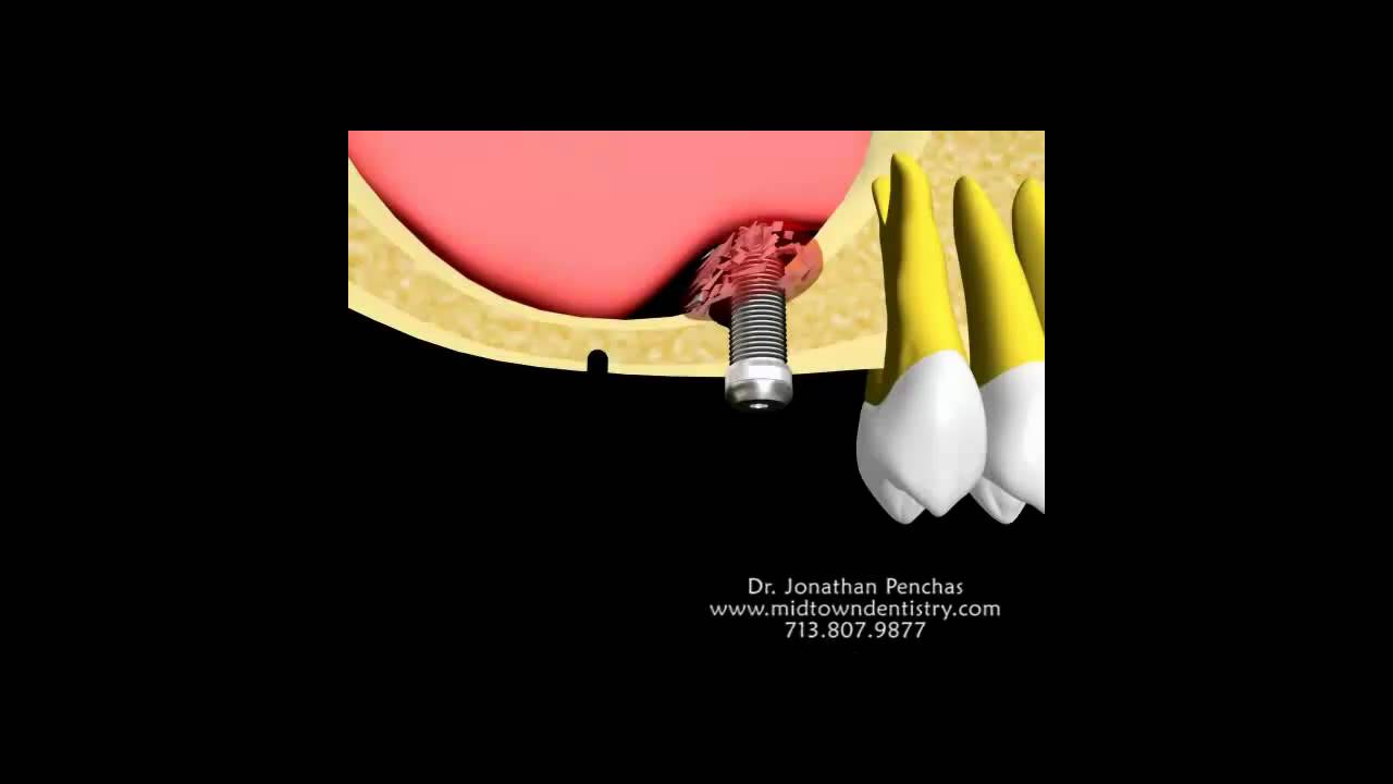houston dental implant - adding bone using the sinus lift