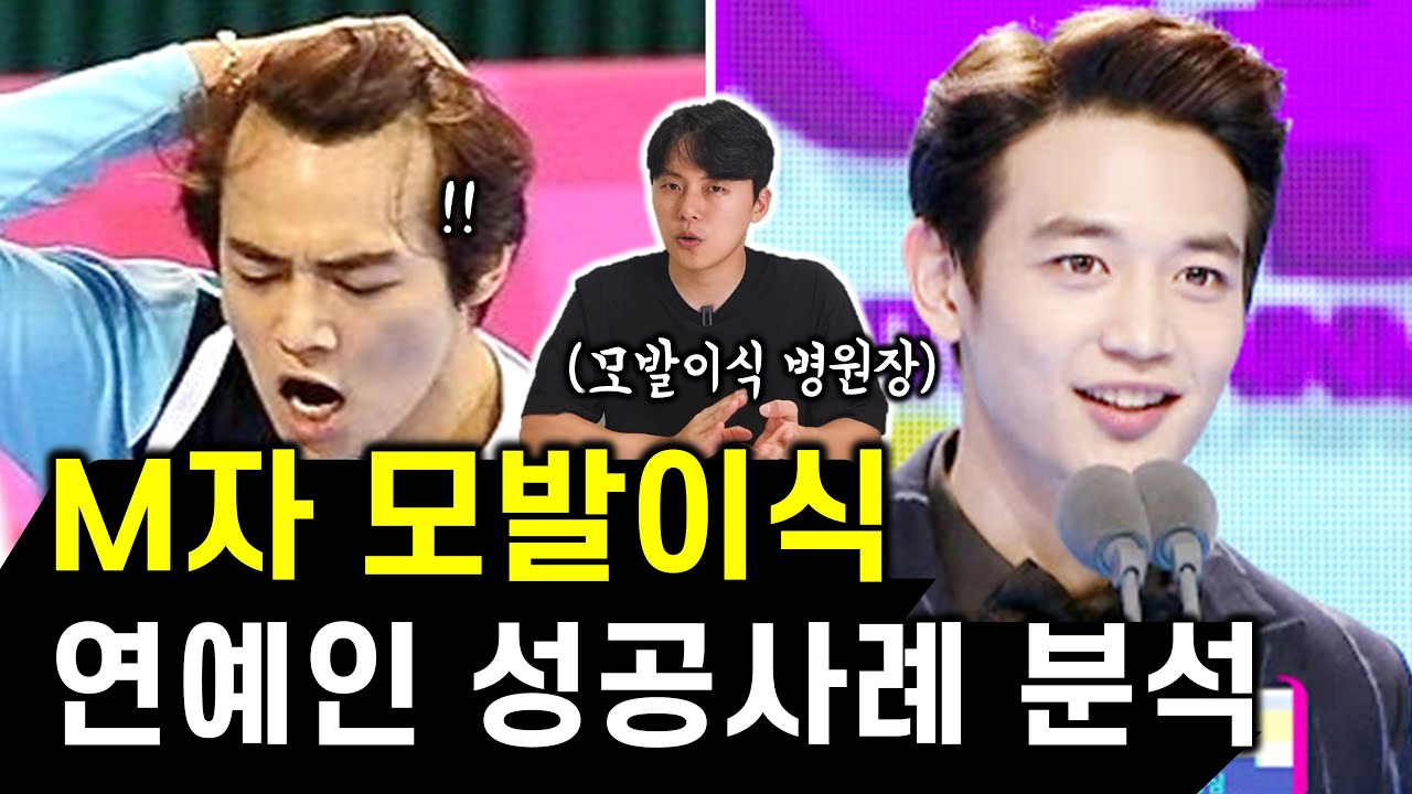 M자 탈모 모발이식 성공한 연예인들, 샤이니 민호부터 정우성까지 전후 사진 분석 (feat. 모발이식 비용, 견적)
