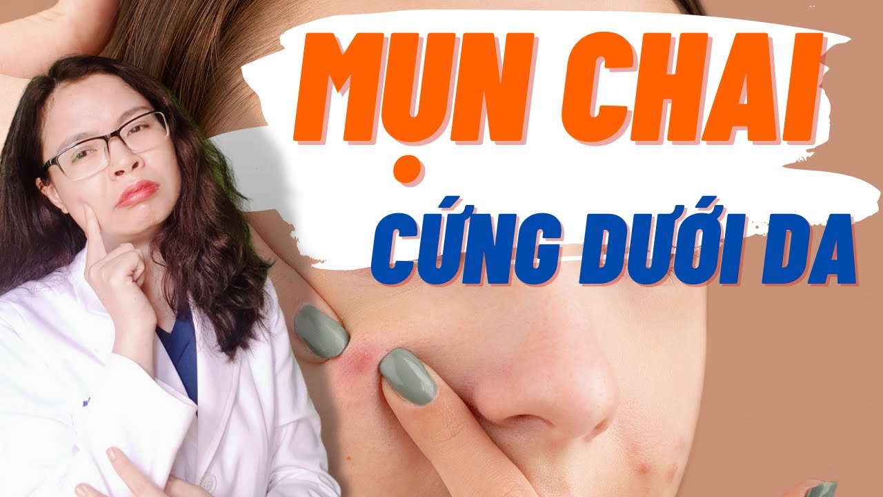 Cách xử lí mụn chai cứng dưới da lâu năm nhanh gọn - Bác sĩ Nguyên