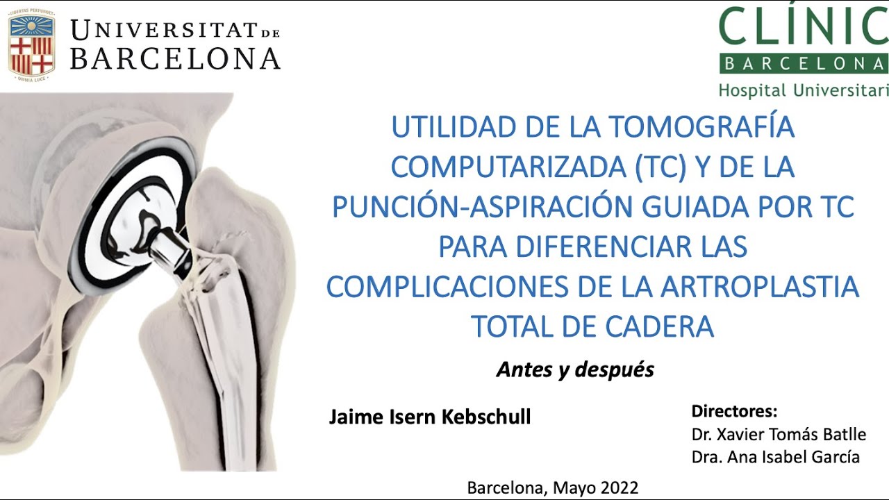 260- Utilidad de TC y punción aspiración guiada TC para diferenciar complicaciones
