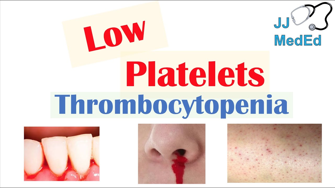 Thrombocytopenia | Signs and Symptoms and Approach to Causes