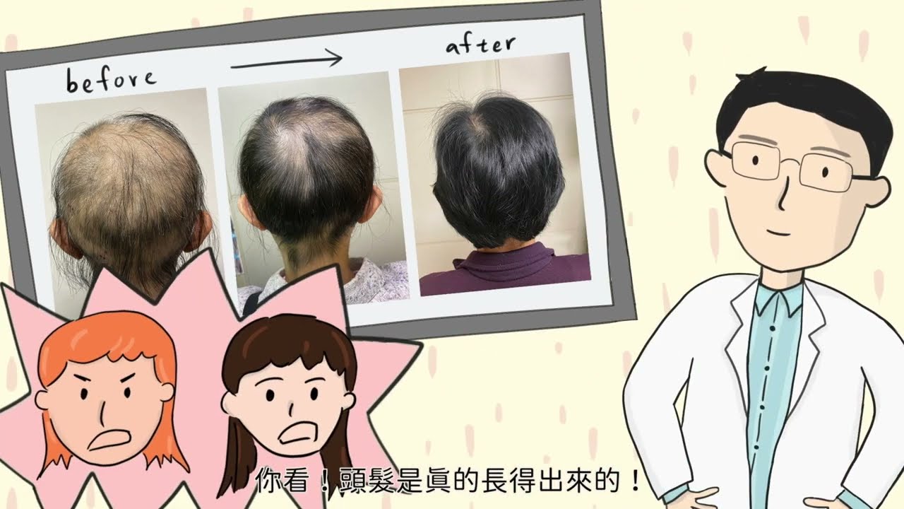 驚!! 頭皮禿一塊? ! 小心免疫疾病鬼剃頭(圓禿)悄悄找上門！！童綜合免疫風濕科幫您重拾『茂密秀髮』