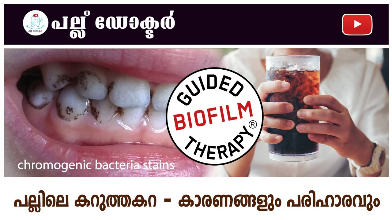 പല്ലിലെ കറുത്തകറ - കാരണങ്ങളും പരിഹാരവും / chromogenic bacteria stains