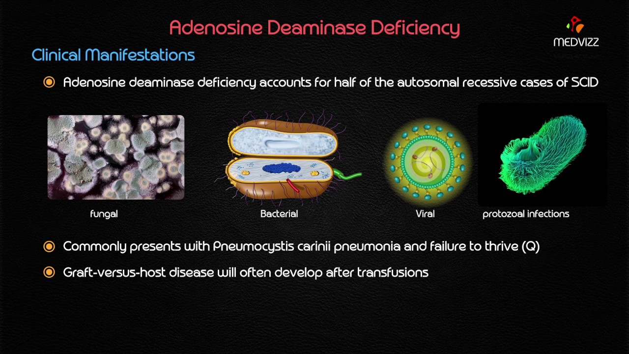 Adenosine deaminase (ADA) deficiency