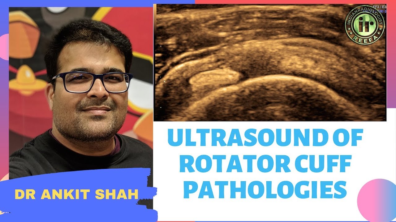 TMT: USG in Rotator Cuff Pathologies by Dr Ankit Shah