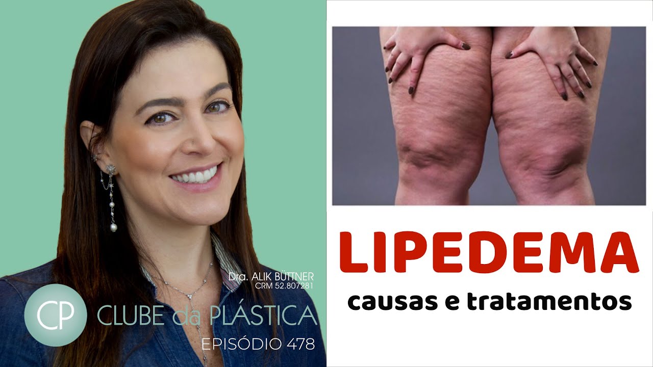 Clube da Plástica: O lipedema - causas e tratamentos