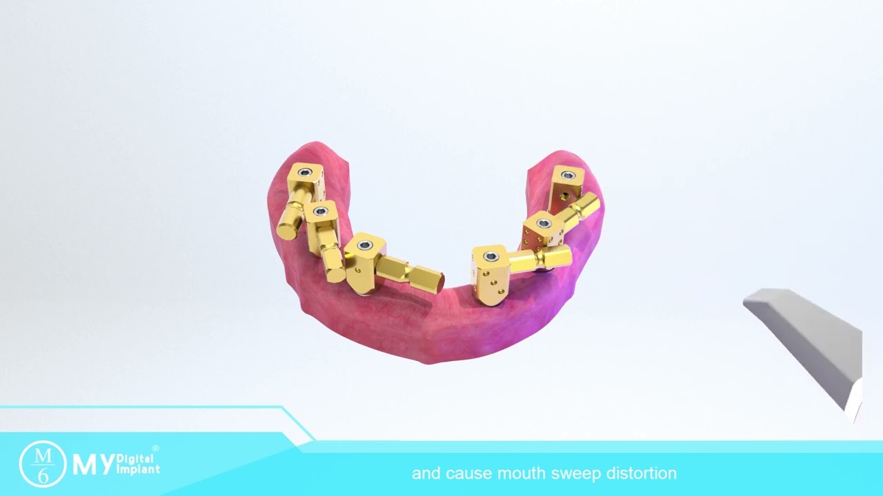 scanbody for edentulous to get digital impression