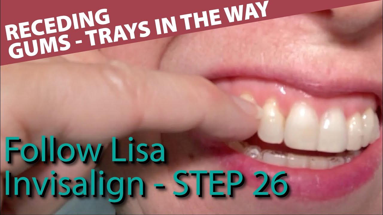 🦷 Invisalign 26 - Receding gums - adjustment on the top of the aligners // Follow Lisa