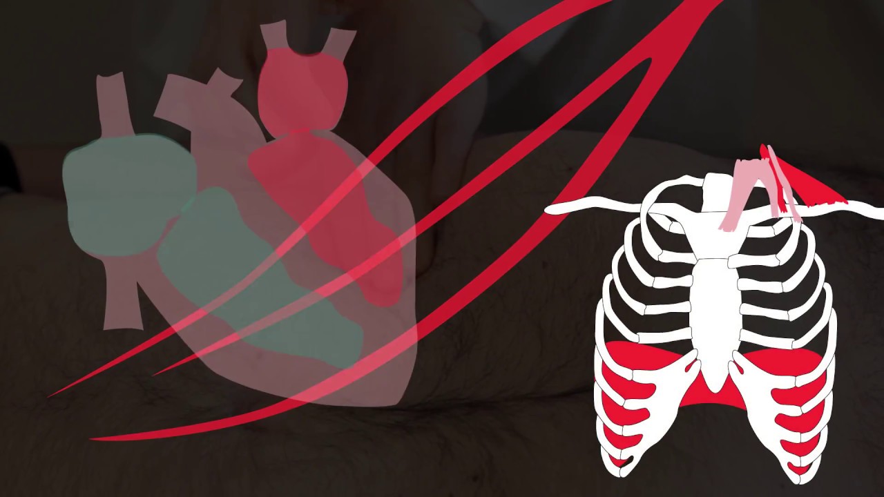 Insuffisance cardiaque droite