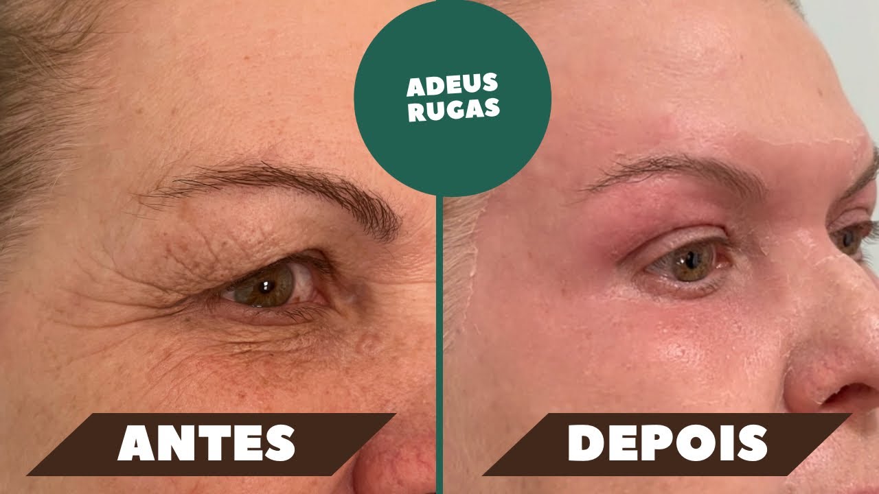 Peeling de Fenol ! Resultado incrível ! Blefaroplastia sem cirurgia! Rugas nos olhos! #fenol
