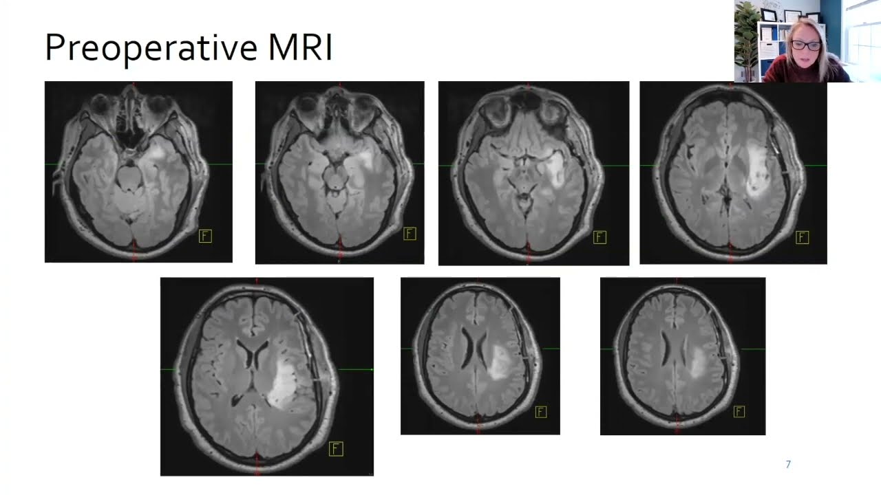 Approach to Focal Epilepsy Secondary to Dominant Temporal Low Grade Gliomas