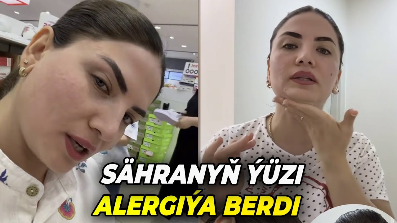 S&Auml;HRANYŇ Y&Uuml;Z&Uuml; ALERGI&Yacute;A BERDI