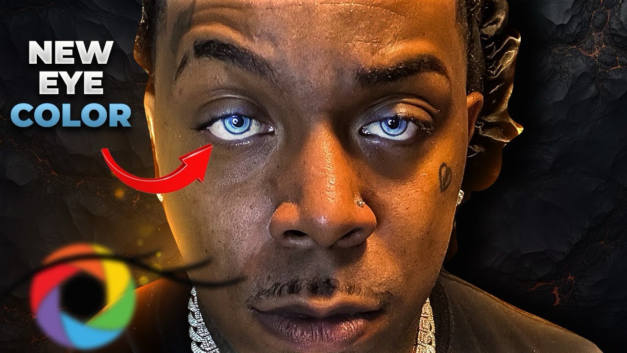92 Gets Eye Color Surgery In New York (KeratoNYC)