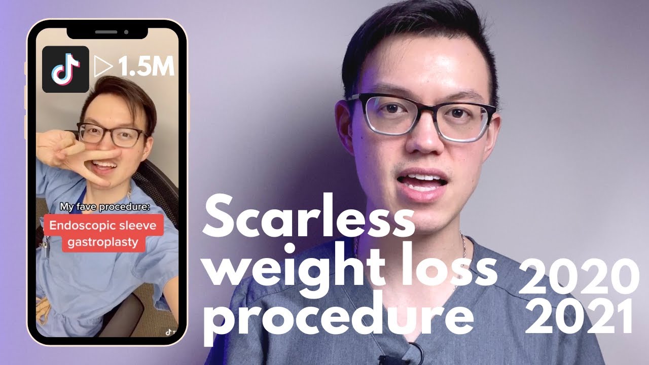 Endoscopic sleeve gastroplasty in 2020/2021 | Most asked questions