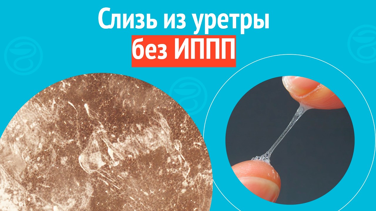 😥 Слизь из уретры без ИППП. Клинический случай № 1762