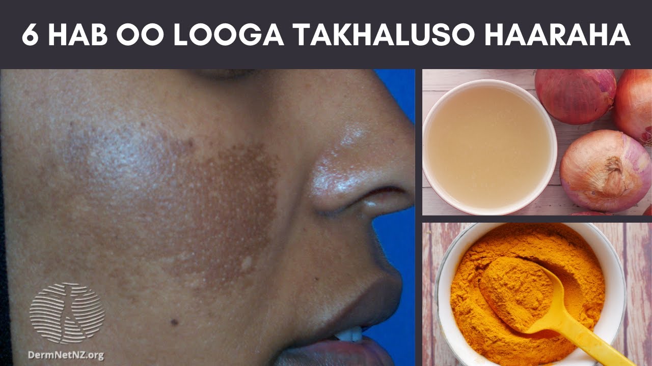 Sababaha Keeno Haaraha Iyo Siyaabaha Looga Takhaluso