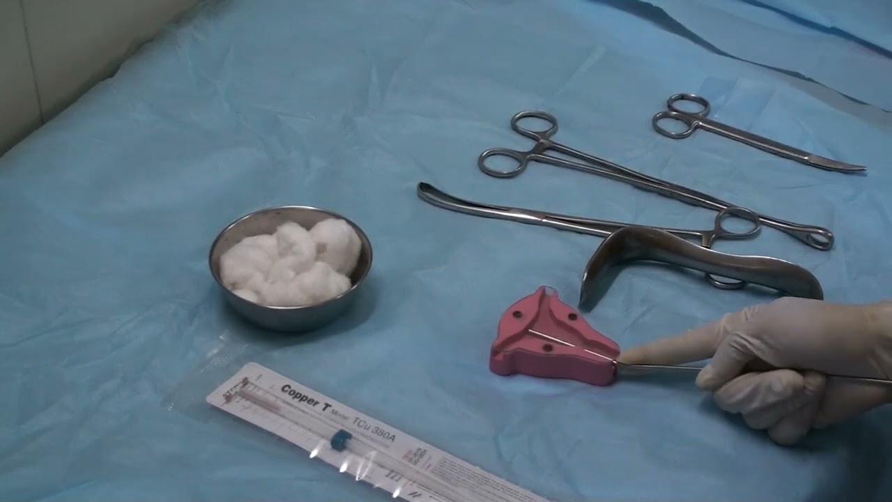 Вставка Cu T (COPPER T 380 A) — от Love Obstetrics & Gynecology