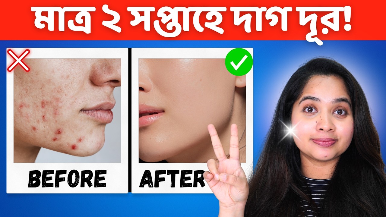 🟢 মাত্র ২ সপ্তাহে ব্রনের কালো দাগ দূর করার উপায় | Get Rid of Acne Spots in 2 Weeks!