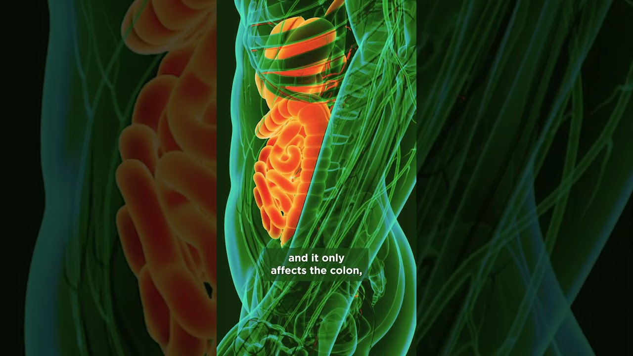 Q&A with a gastroenterologist: Diet and IBD