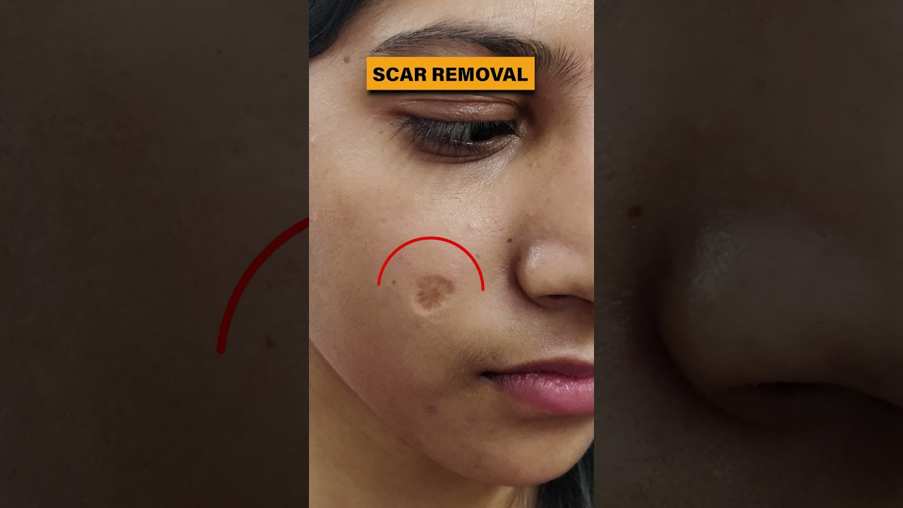 Scar Removal Treatment in Delhi | Scar removal results before and after 