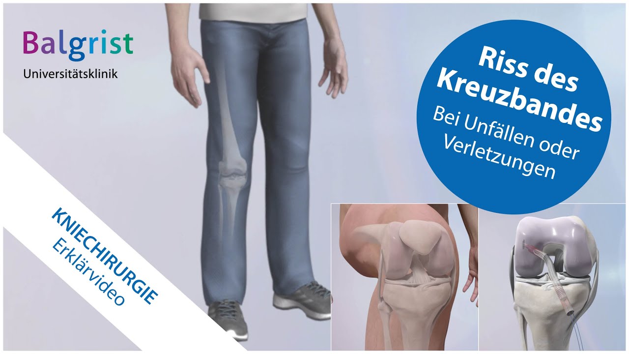 Kreuzbandriss: operative Behandlung vordere Kreuzbandruptur