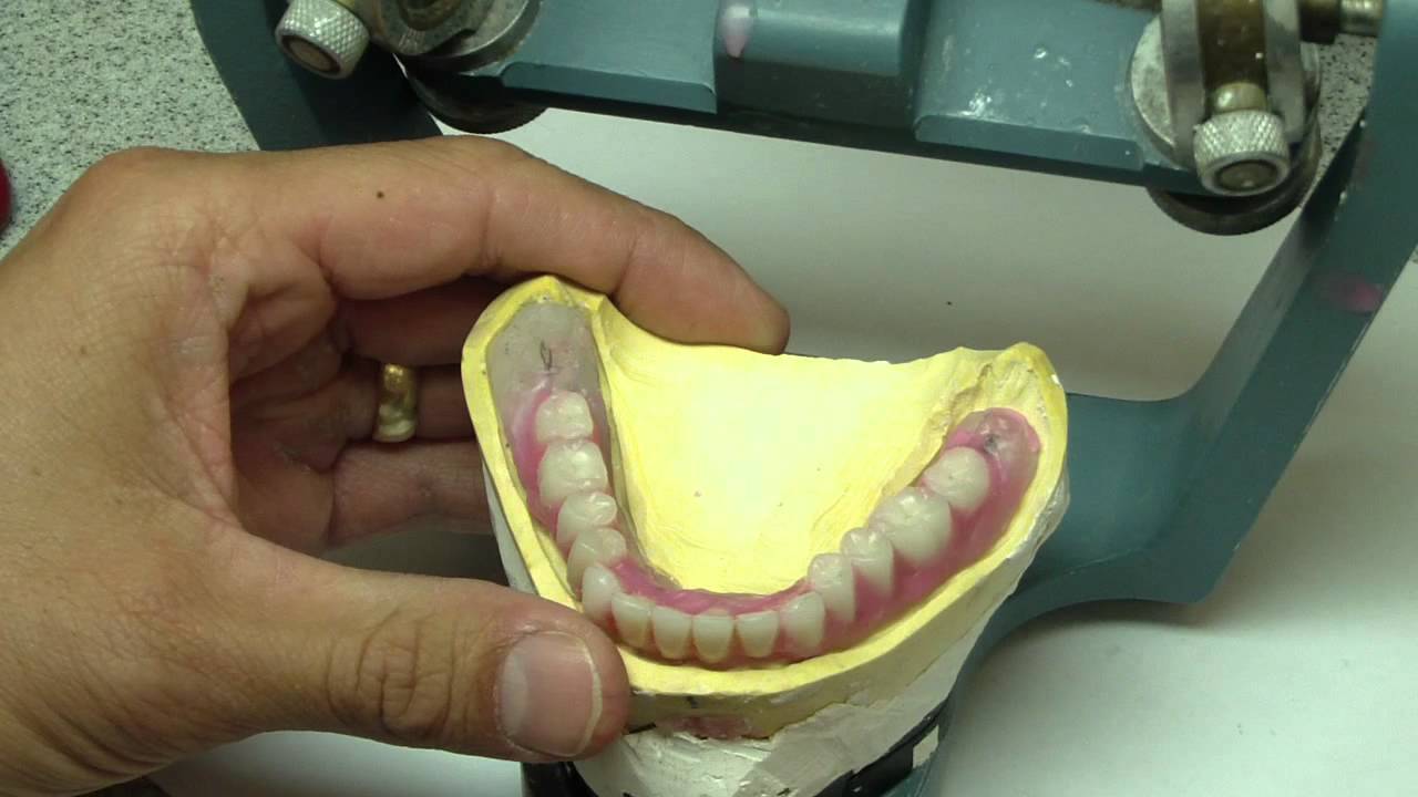 Lingualized Occlusion