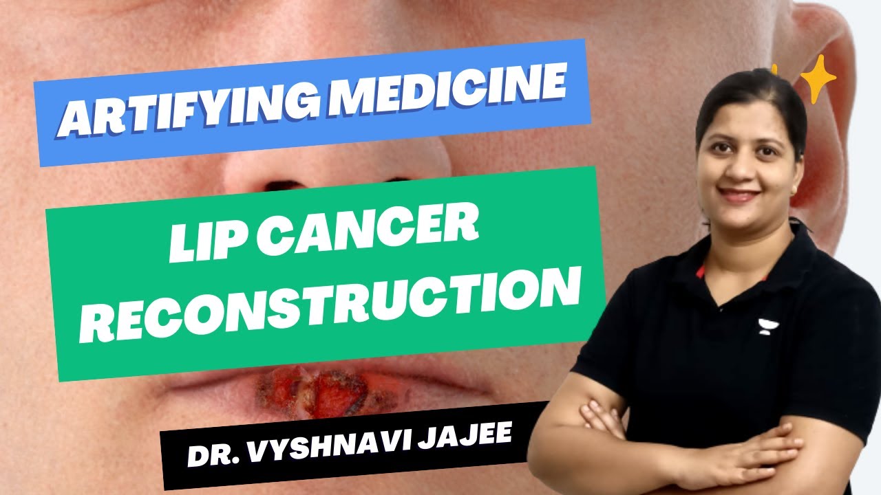 Lip Cancer Reconstruction Methods | Artifying Medicine Ep 1 | ENT with Dr. Vyshnavi Jajee