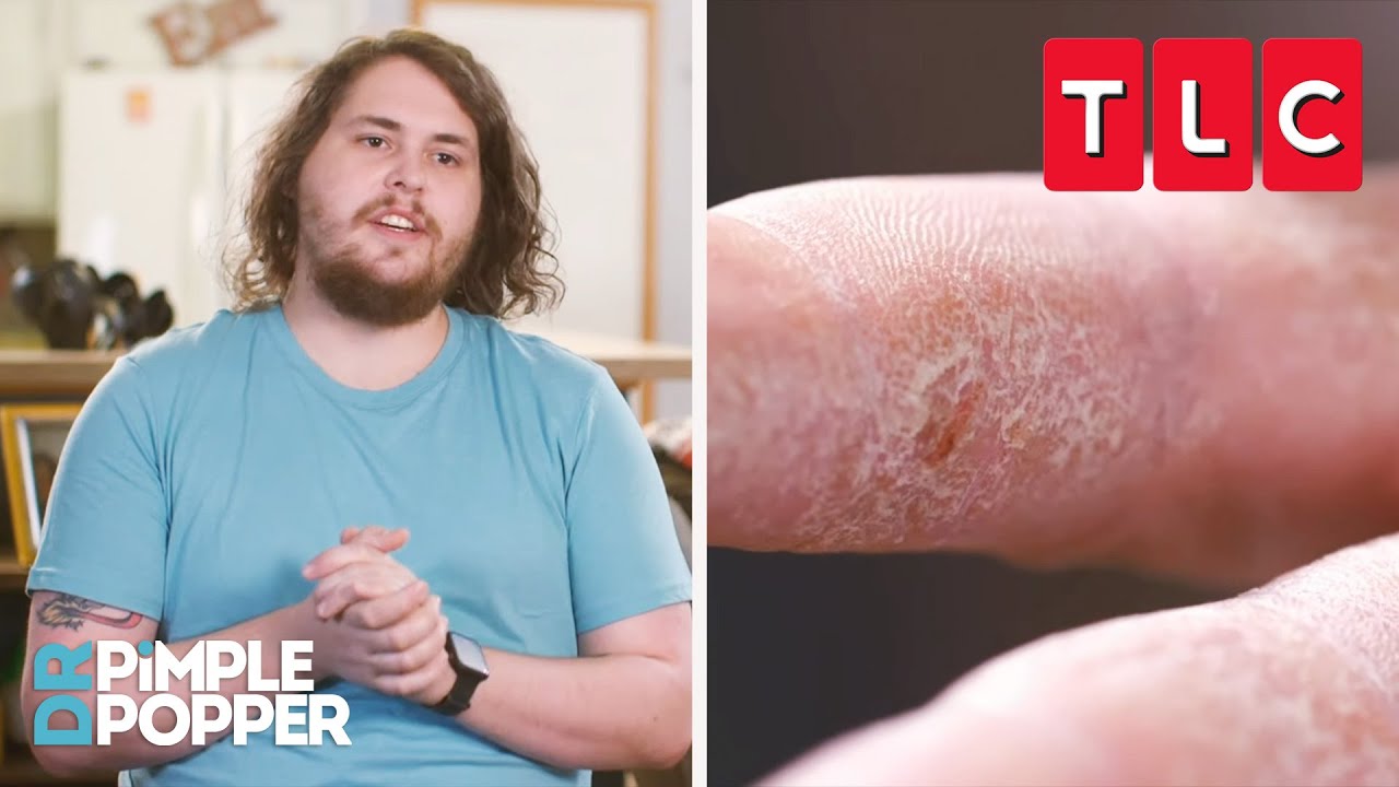 NOTHING Can Help This Man&rsquo;s Unbearably Dry Skin | Dr. Pimple Popper | TLC
