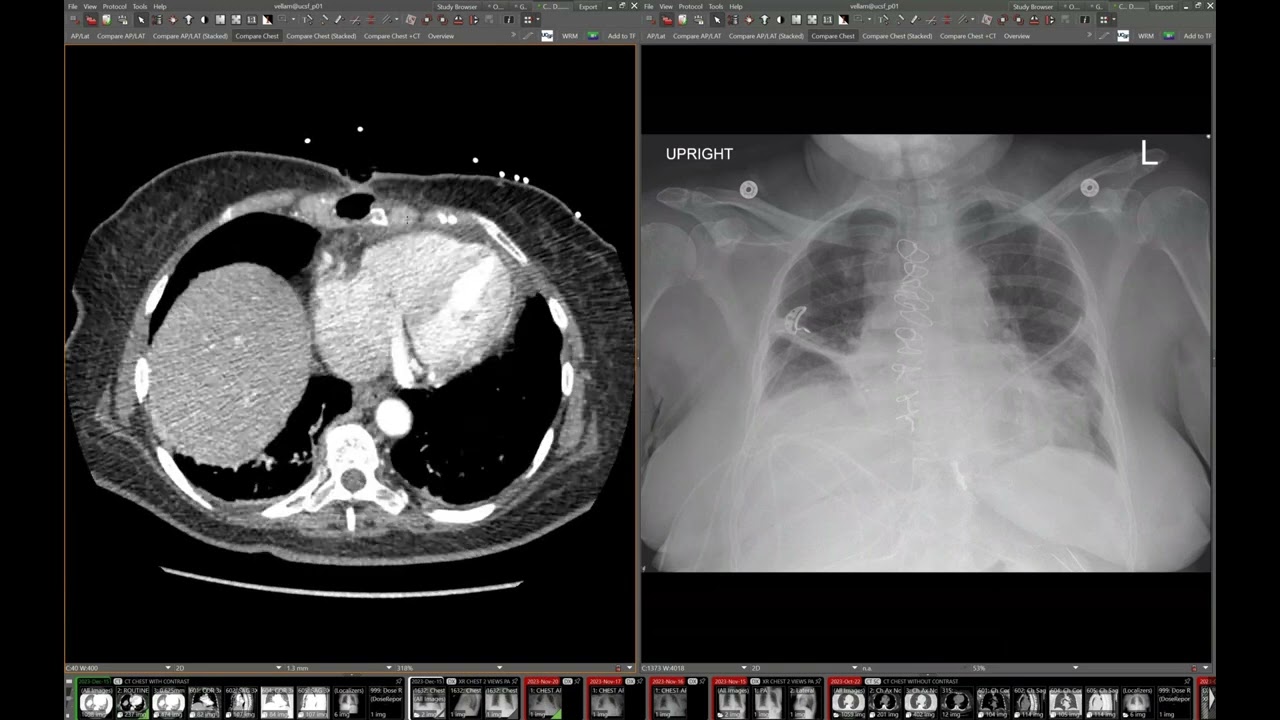 STR Cardiothoracic Case Webinar 4/25/2024
