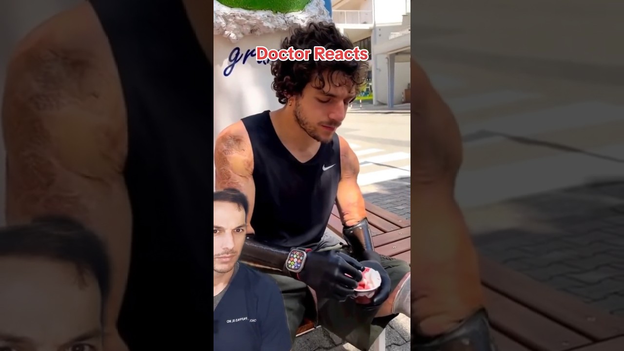 Роботизированные руки! #Миоэлектрический #Протез #Ампутация #ИскусственныйИнтеллект #медик #врач