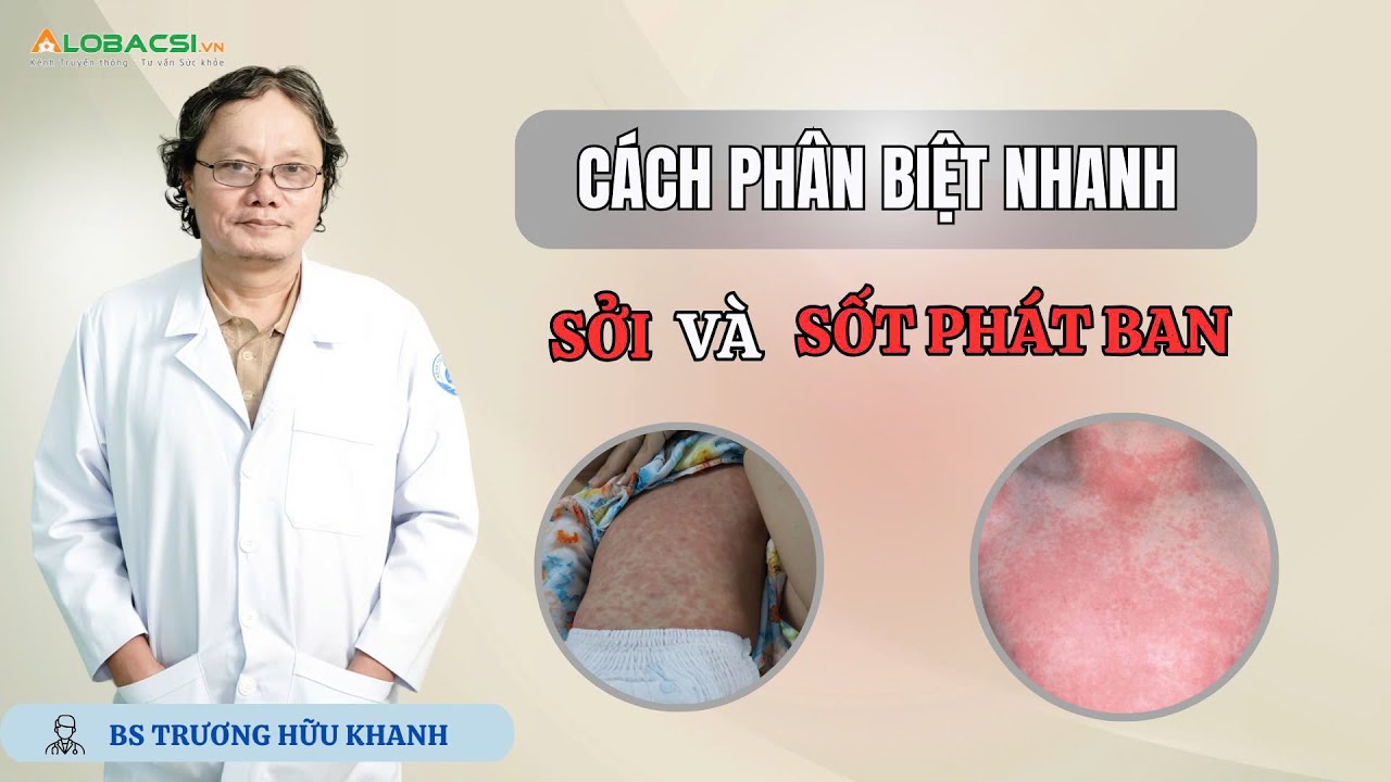 CÁCH PHÂN BIỆT NHANH SỞI VÀ SỐT PHÁT BAN | BS TRƯƠNG HỮU KHANH | VIDEO ALOBACSI