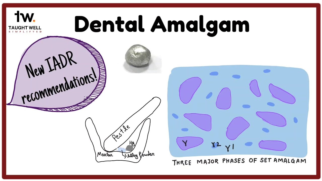 Dental Amalgam | New IADR recommendations | Dental Materials