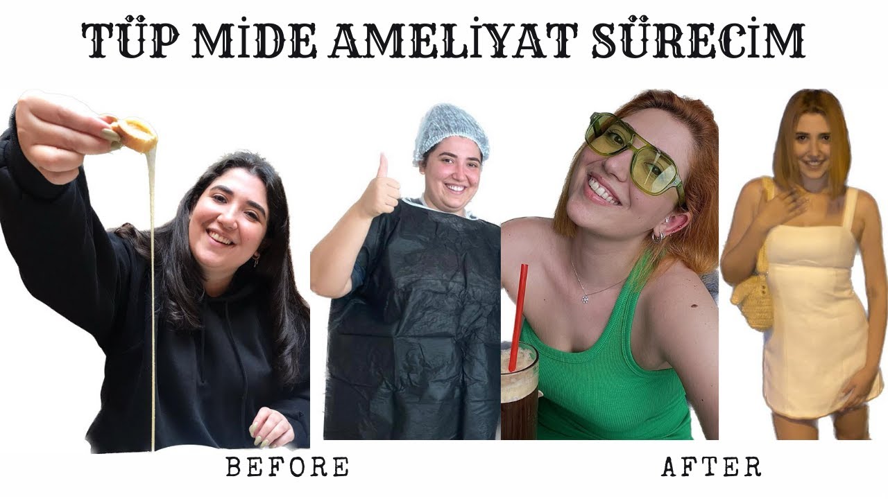 TÜP MİDE AMELİYATIM |Kaç kilo verdim? |Ameliyat Ücreti |Sarkıklarım ve çatlaklarım |Ameliyat izlerim