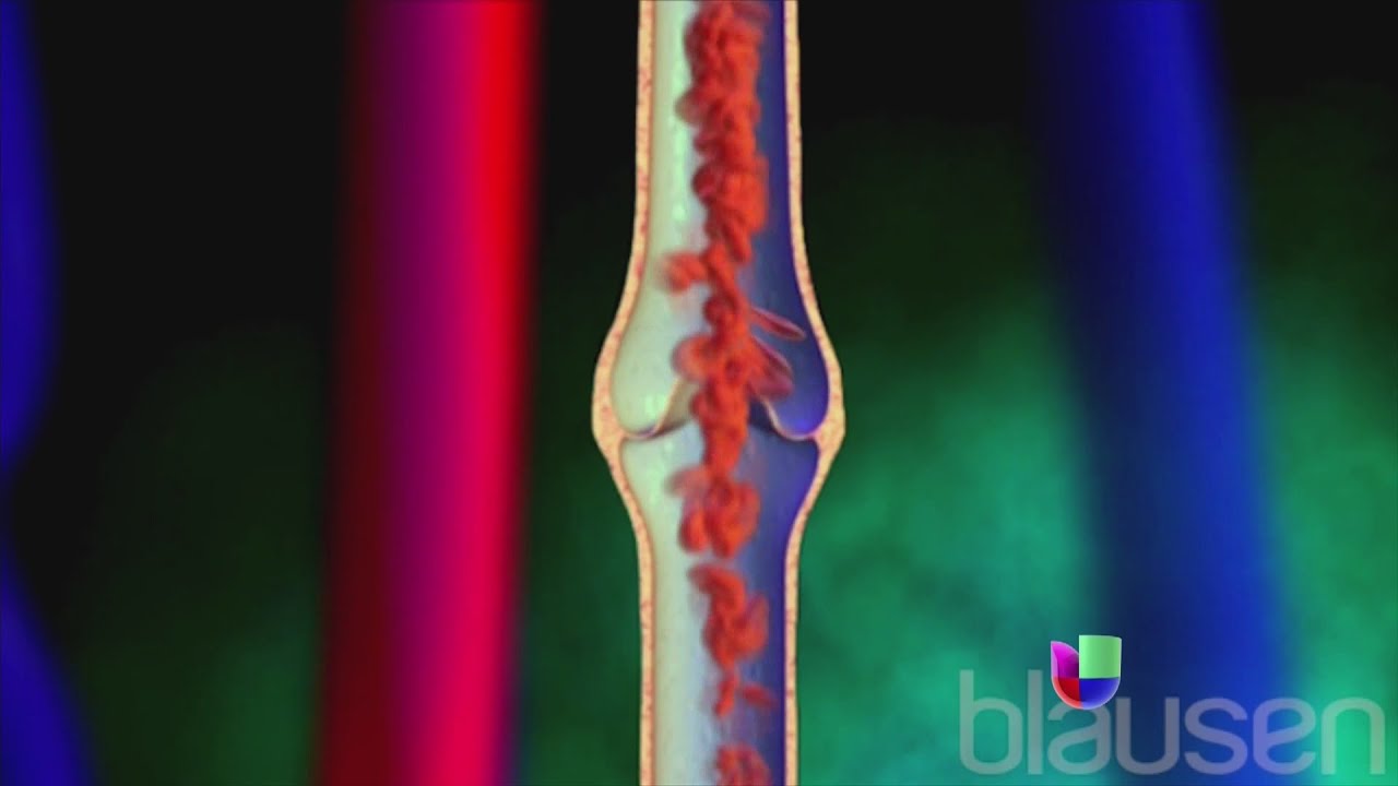 Las venas varicosas y su impacto en la salud