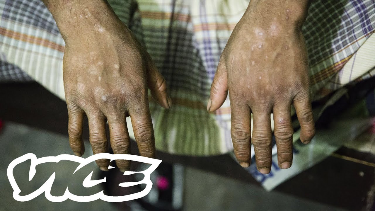 Toxic Tanneries Poisoning Workers in Bangladesh