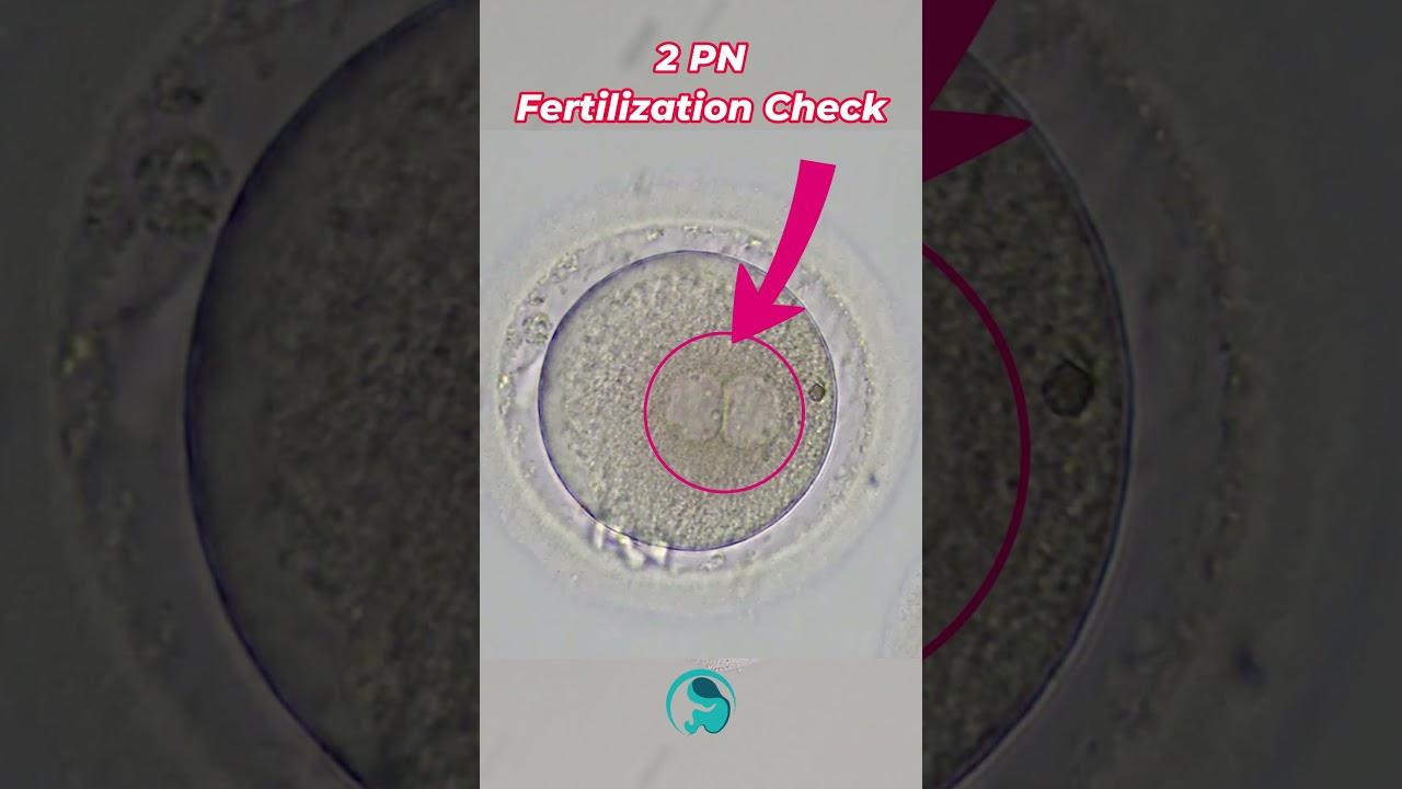 What is ICSI? Step-by-Step Fertility Procedure Explained by an Embryologist