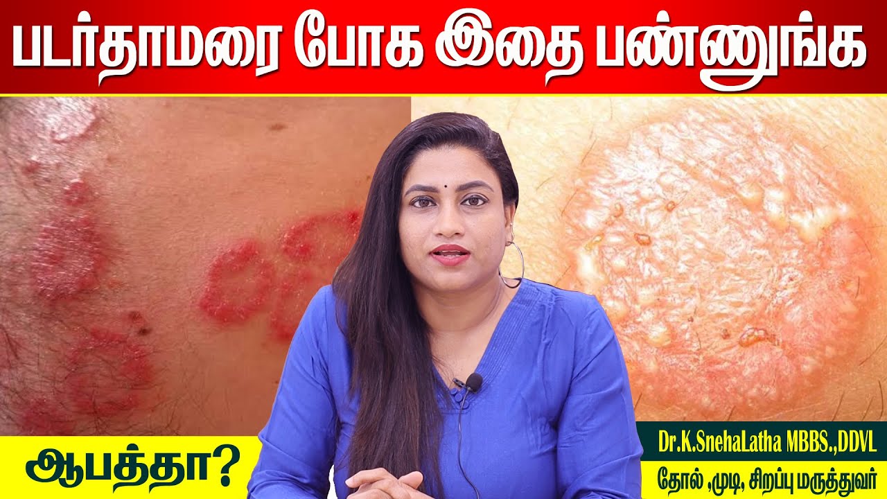 படர்தாமரை முற்றிலும் குணமாக | Home remedies | Foods | How to cure ringworm permanently? | Itching