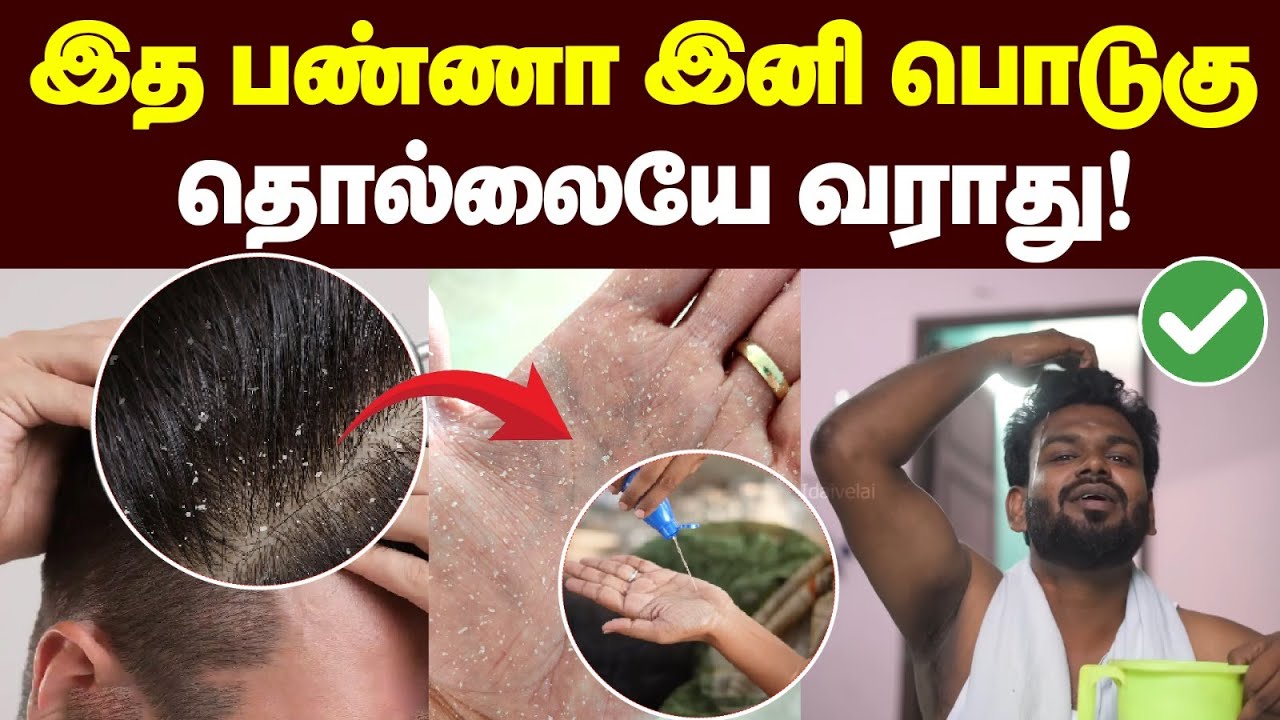 பொடுகு தொல்லை இனி இல்லை! நச்சுனு நாலு டிப்ஸ் | Dandruff | dandruff treatment at home | Men & Women