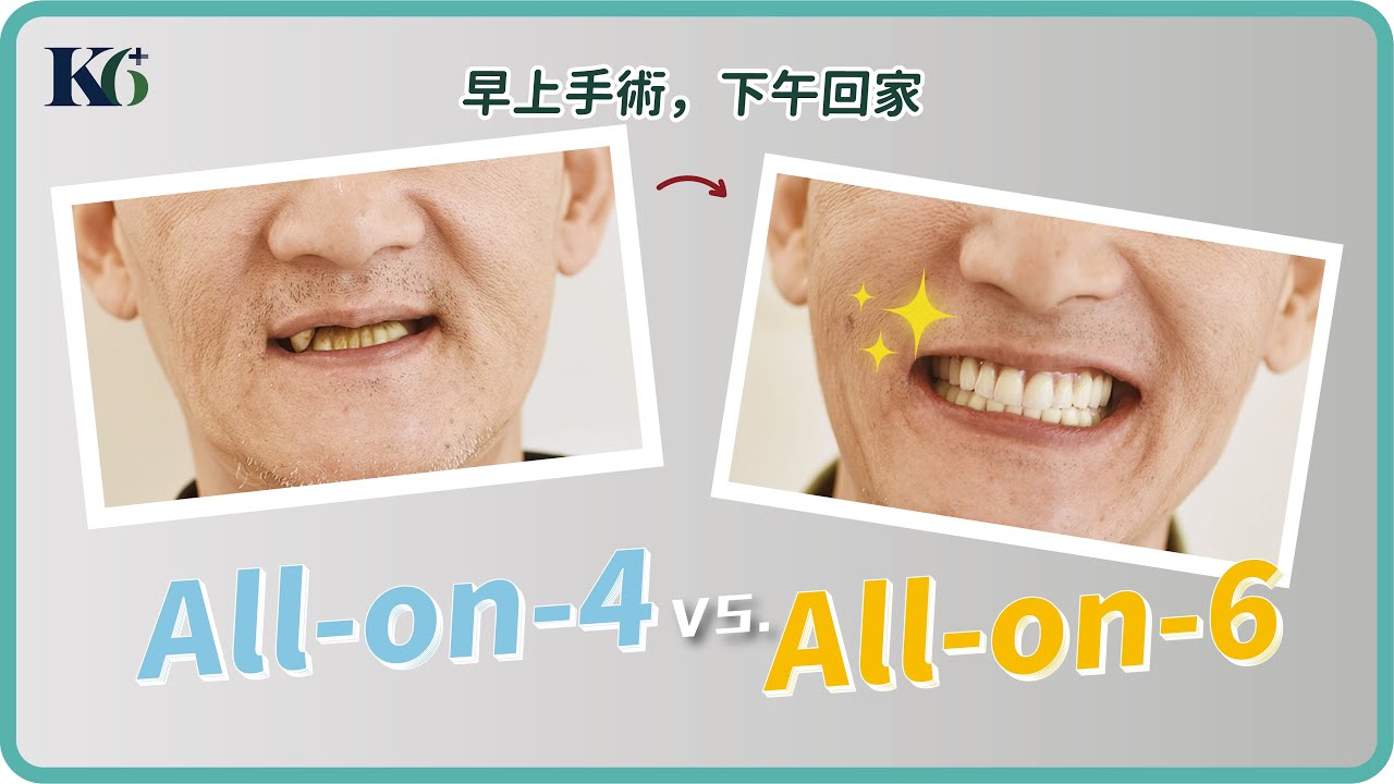 快速全口重建👉All-on-4 和 All-on-6 差在哪? 康智為醫師專業分析！🧐