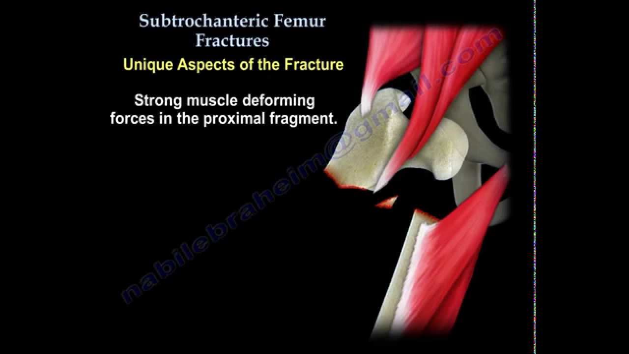 Subtrochanteric Femur Fractures - Everything You Need To Know - Dr. Nabil Ebraheim