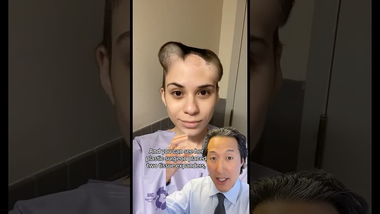 Scalp Reconstruction After Melanoma Removal- Before and After!