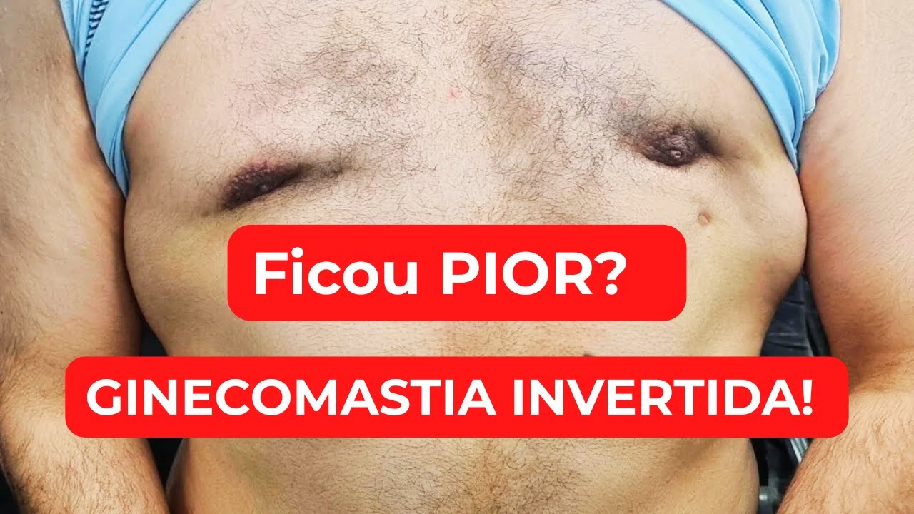 Ginecomastia Invertida - Como resolver? [Dr. Jacintho - Cirurgi&atilde;o Pl&aacute;stico]
