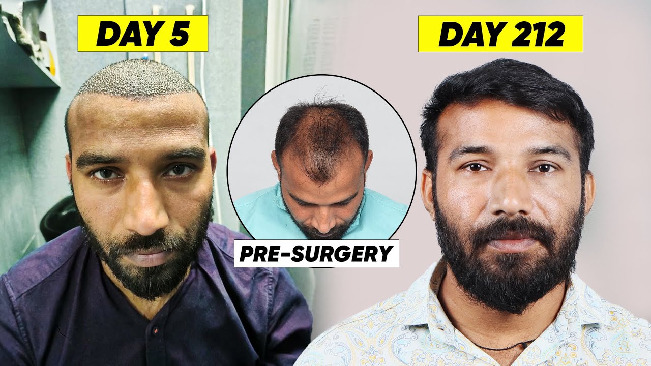 Best Hair Transplant in Delhi (HX-SEWQ) | Best Results & Cost of Hair Transplant in Delhi.