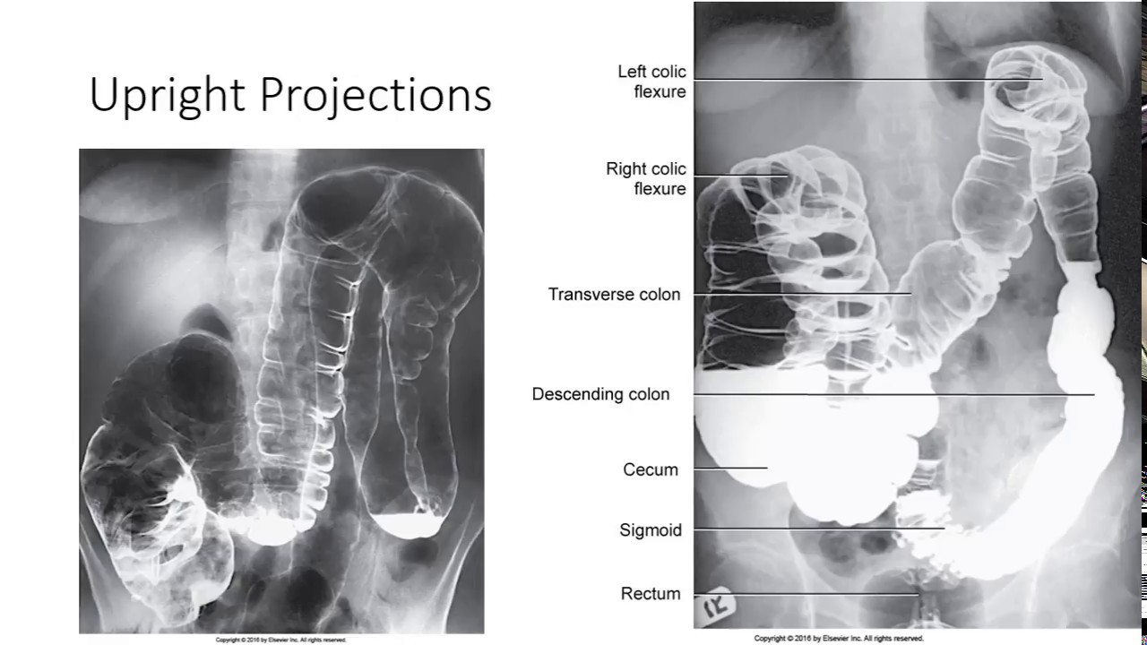 Radiographic Positioning of the Large Intestine