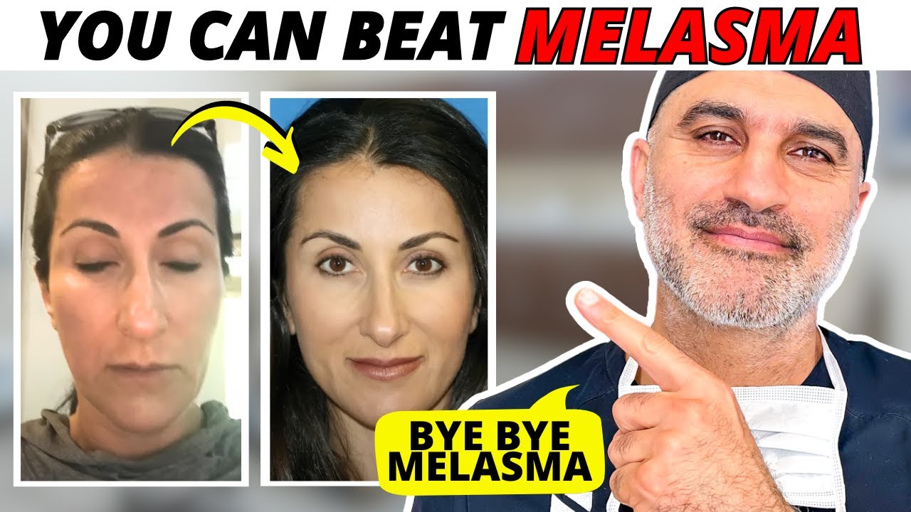 Как доктор Амир Карам вылечил мелазму своей жены ДОМА! Шаг за шагом!