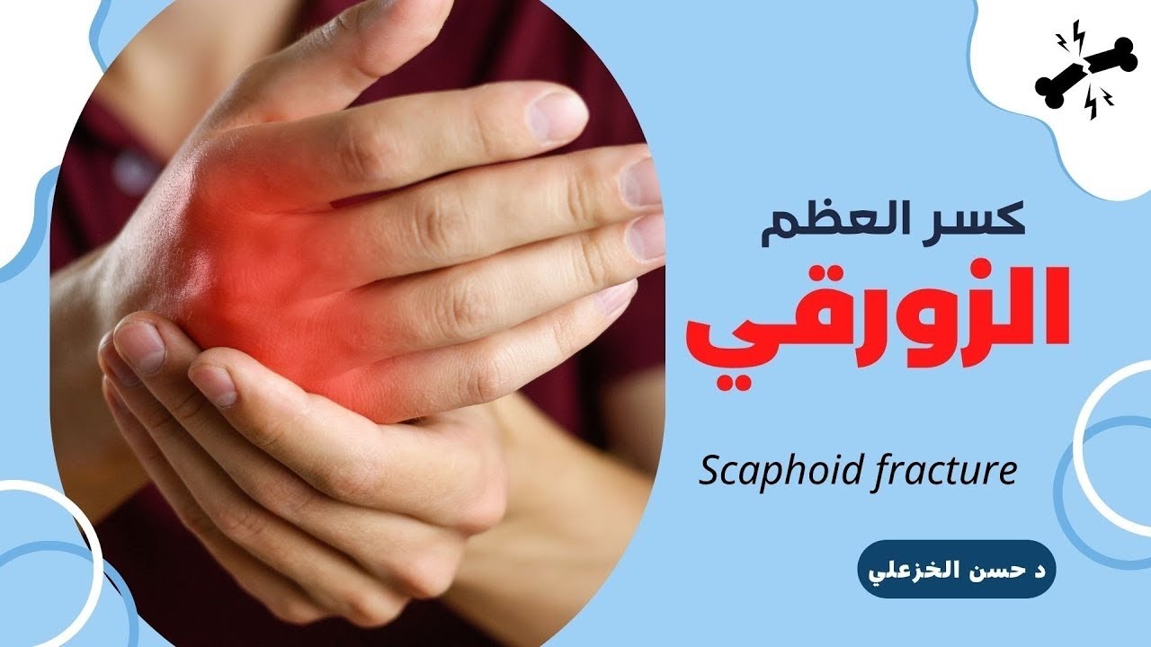 كسر العظم الزورقي الاسباب والعلاج