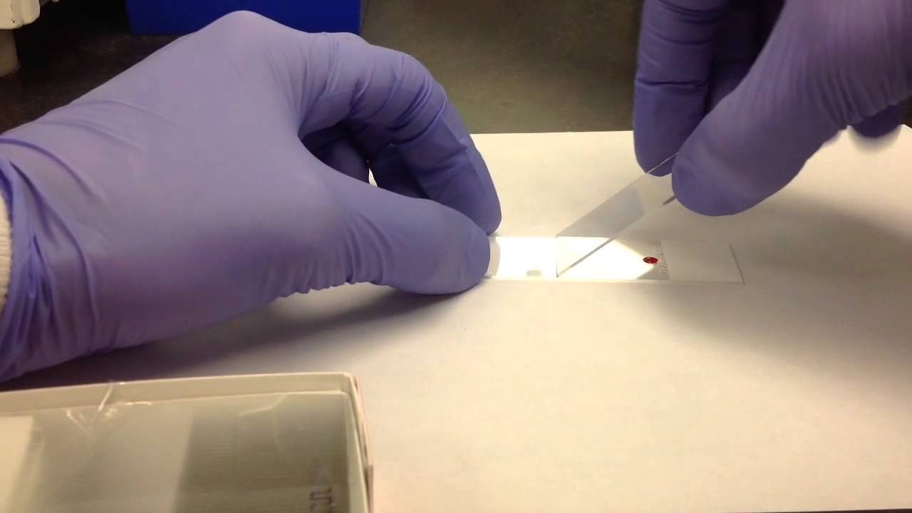 Hematology- Making a Peripheral Blood Smear