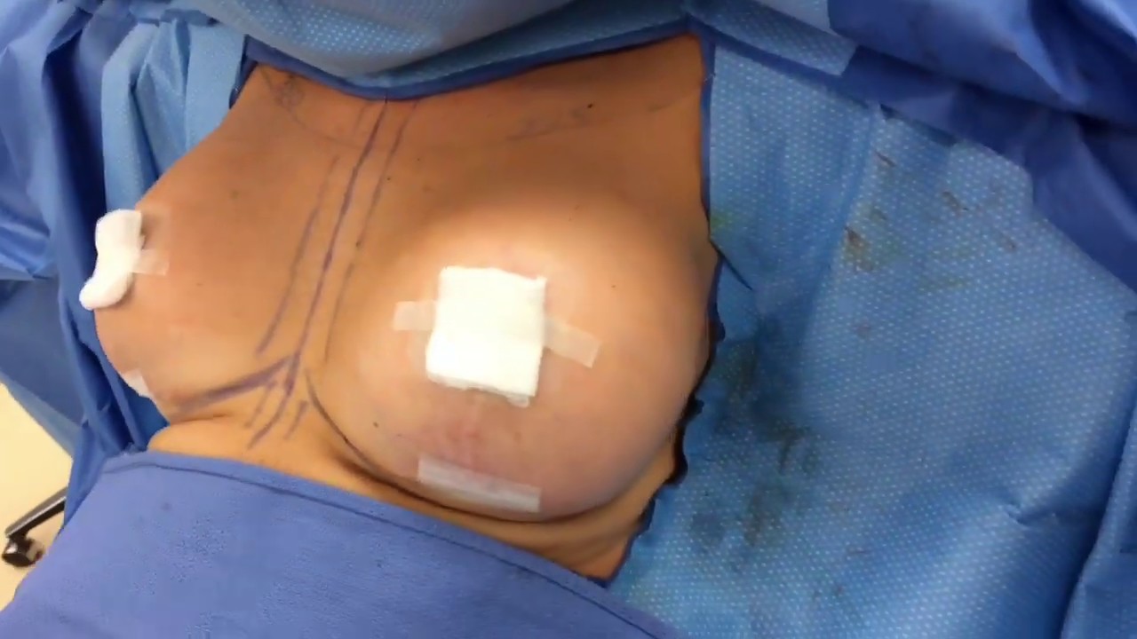 Breast Augmentation with Implants - Before and After -  Dr.  Anthony Youn